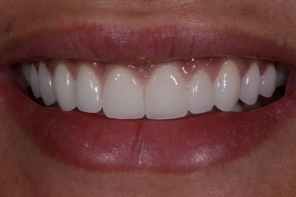After whitening treatment